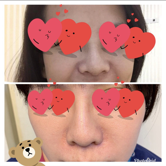微創縮鼻翼 - 