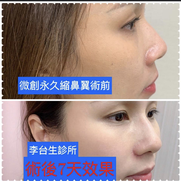 微創縮鼻翼 -