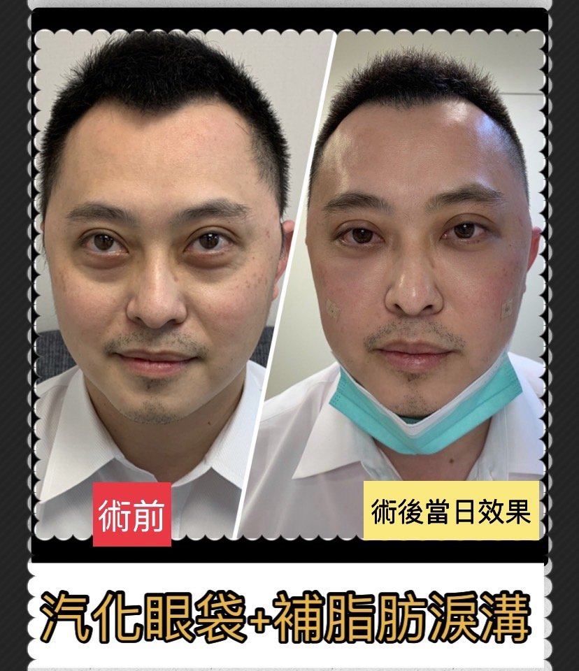 型男業務二~三部曲, 淚溝填補, 黑眼圈去除 - 