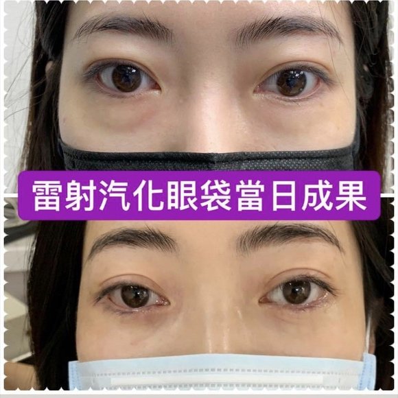 雷射汽化眼袋術當日成果 - 