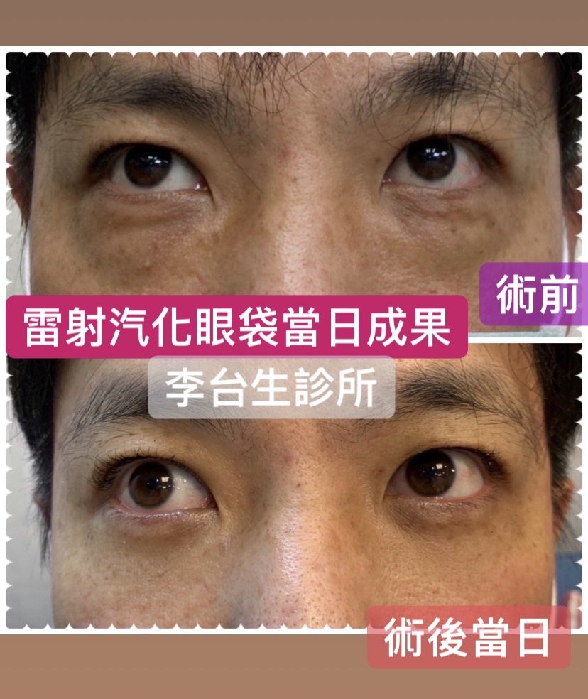 雷射汽化眼袋當日成果 - 