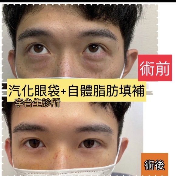 雷射汽化眼袋~自體脂肪填補淚溝 - 