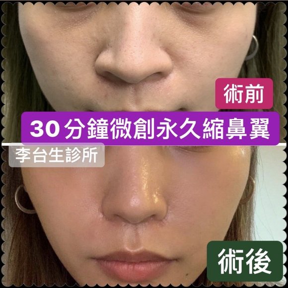 30分鐘微創縮鼻翼 -