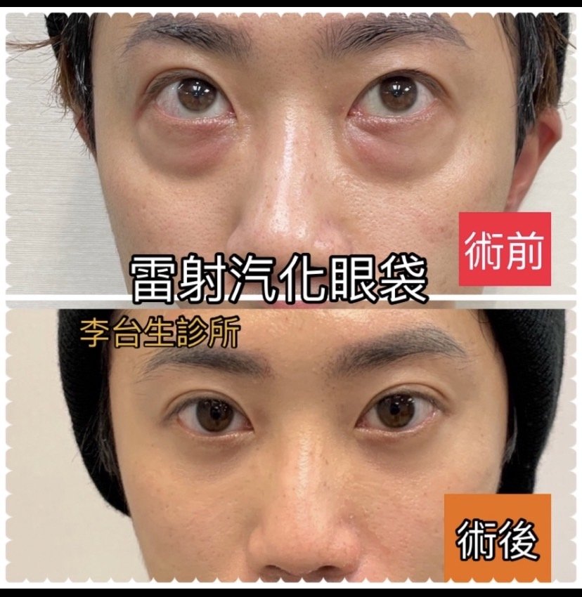 雷射汽化眼袋當天效果 - 