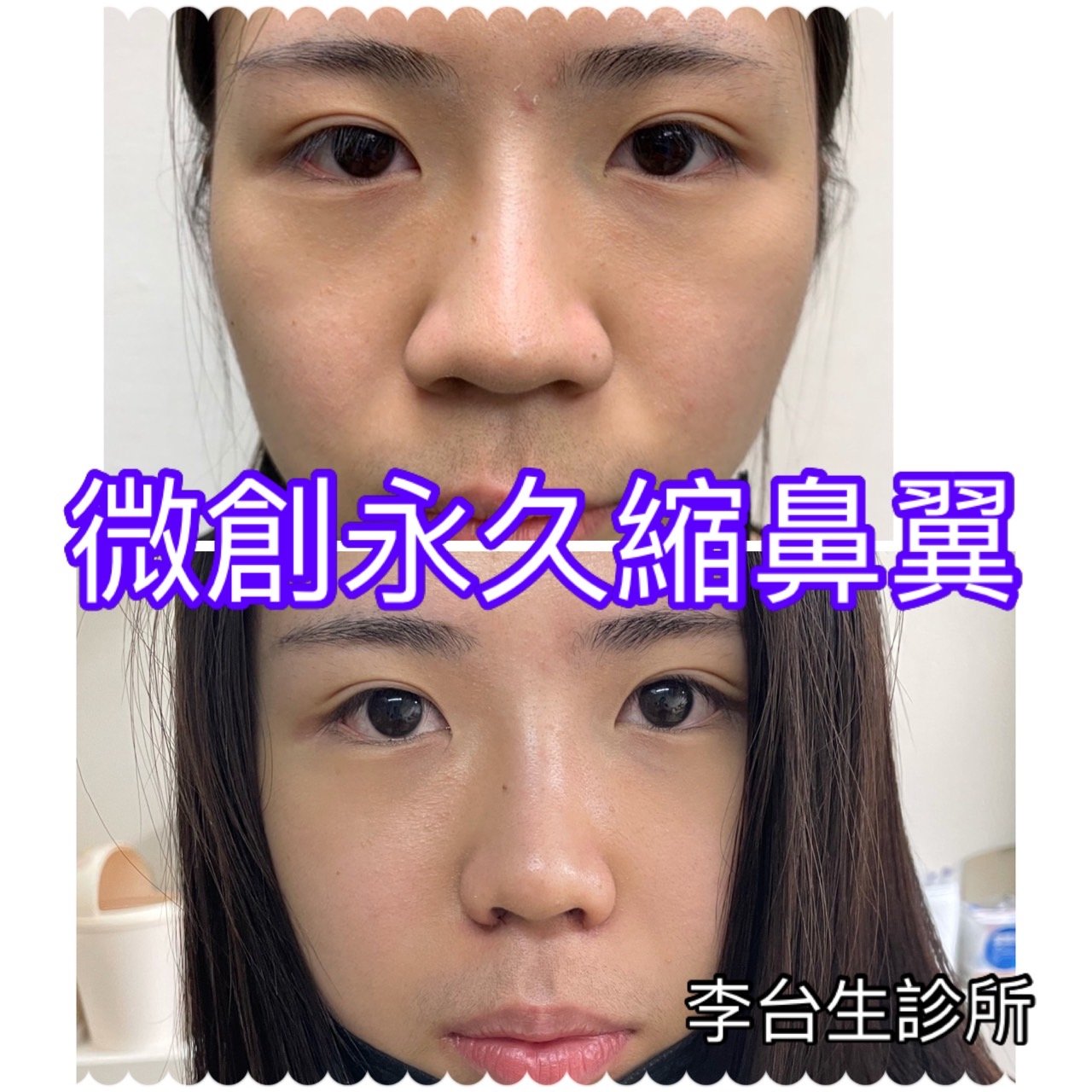 微創永久縮鼻翼術 - 