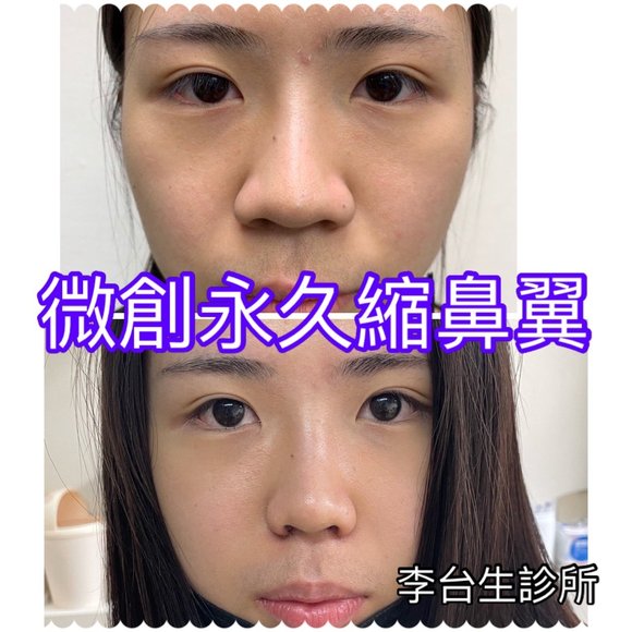 微創永久縮鼻翼術 - 
