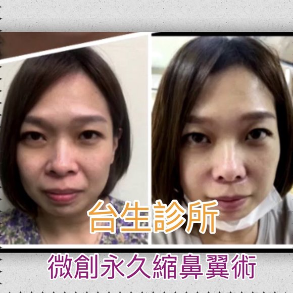 微創永久縮鼻翼術 -