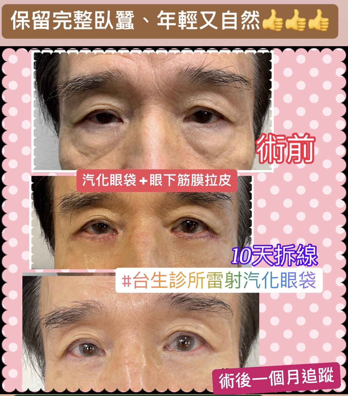 雷射汽化眼袋術~術後一個月追蹤 - 