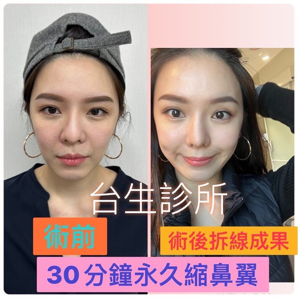 台生診所真實呈現永久縮鼻翼當日術前術後真實情形、及10天後拆線成果。 -