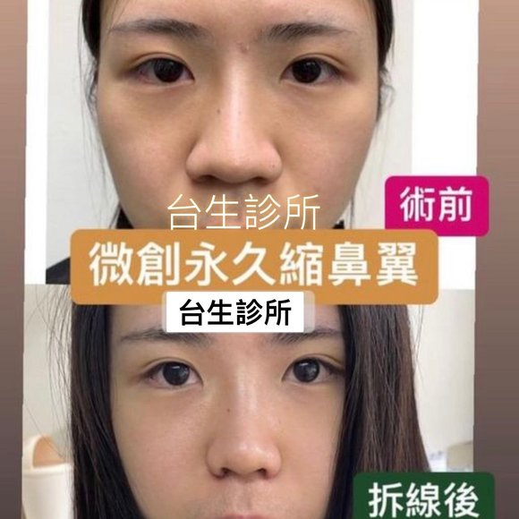 微創永久縮鼻翼術前術後 -