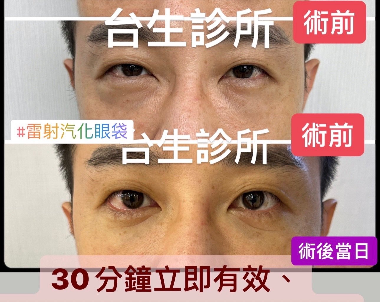 30分鐘雷射汽化眼袋立即有效~年輕又自然 - 