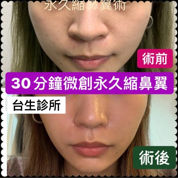 微創永久縮鼻翼效果 -