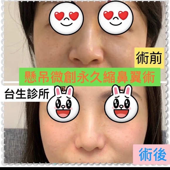 30分鐘微創永久縮鼻翼術後拆線成果 -