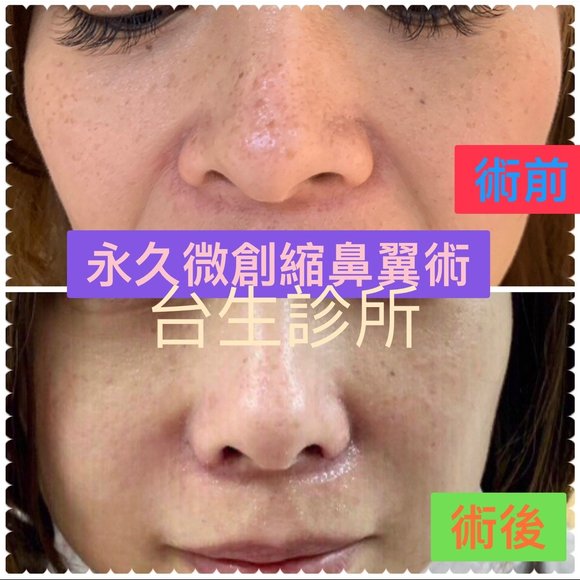 內有影片介紹: 30分鐘微創永久縮鼻翼術~達到永久縮鼻翼變小的手術方式 -