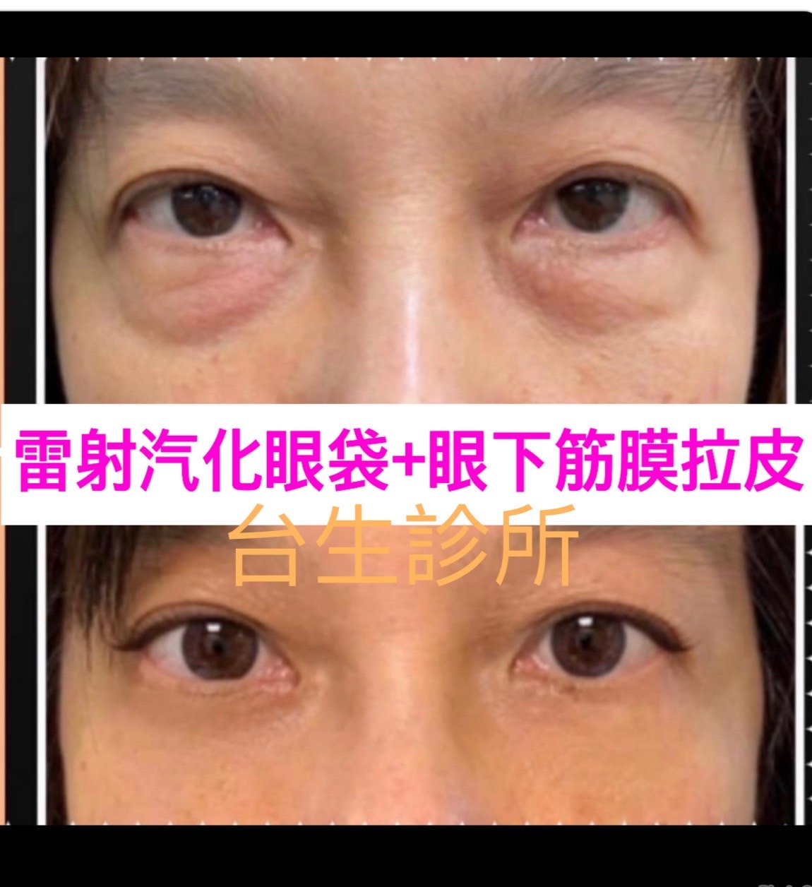 30分鐘雷射汽化眼袋+眼下筋膜拉皮 - 