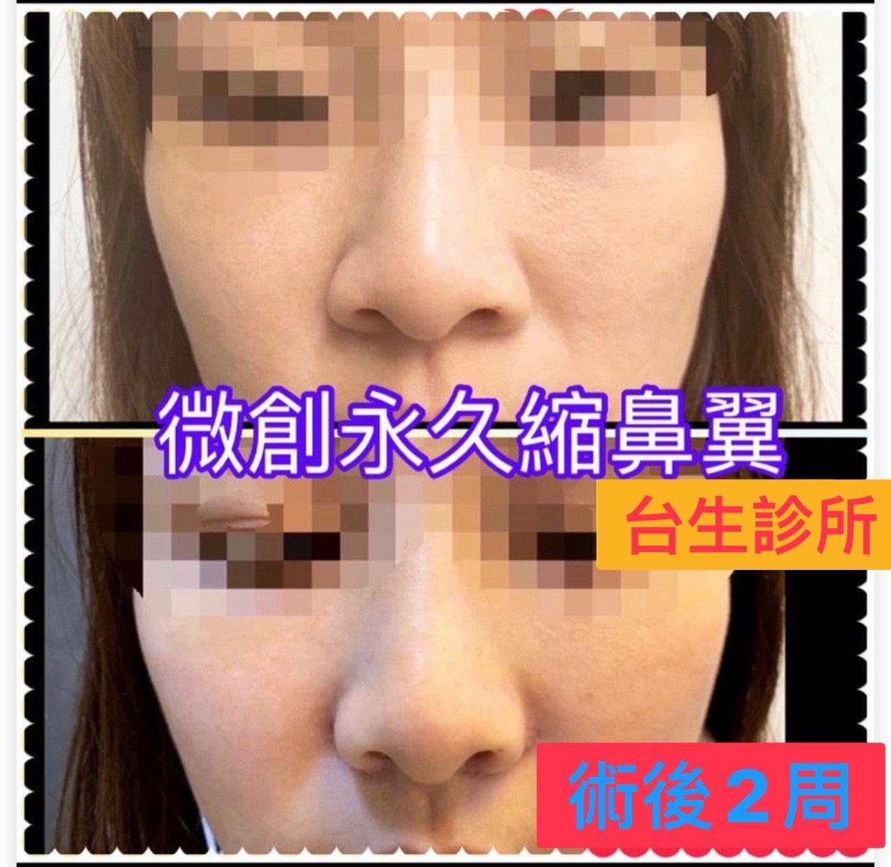 30分鐘微創永久縮鼻翼~術後2周恢復效果 - 