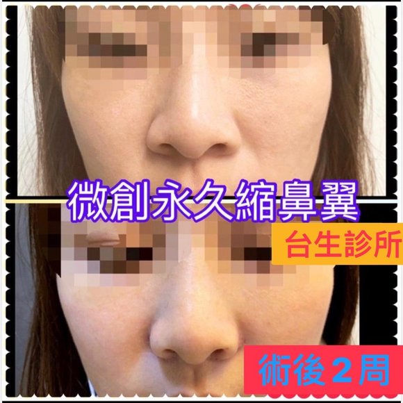 30分鐘微創永久縮鼻翼~術後2周恢復效果 - 