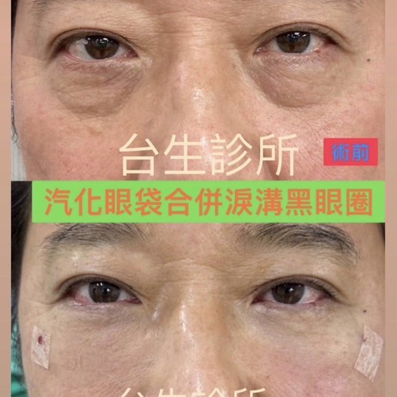 30分鐘雷射汽化眼袋+淚溝黑眼圈 - 