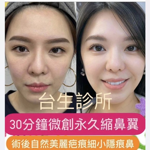 30分鐘微創永久縮鼻翼效果 -