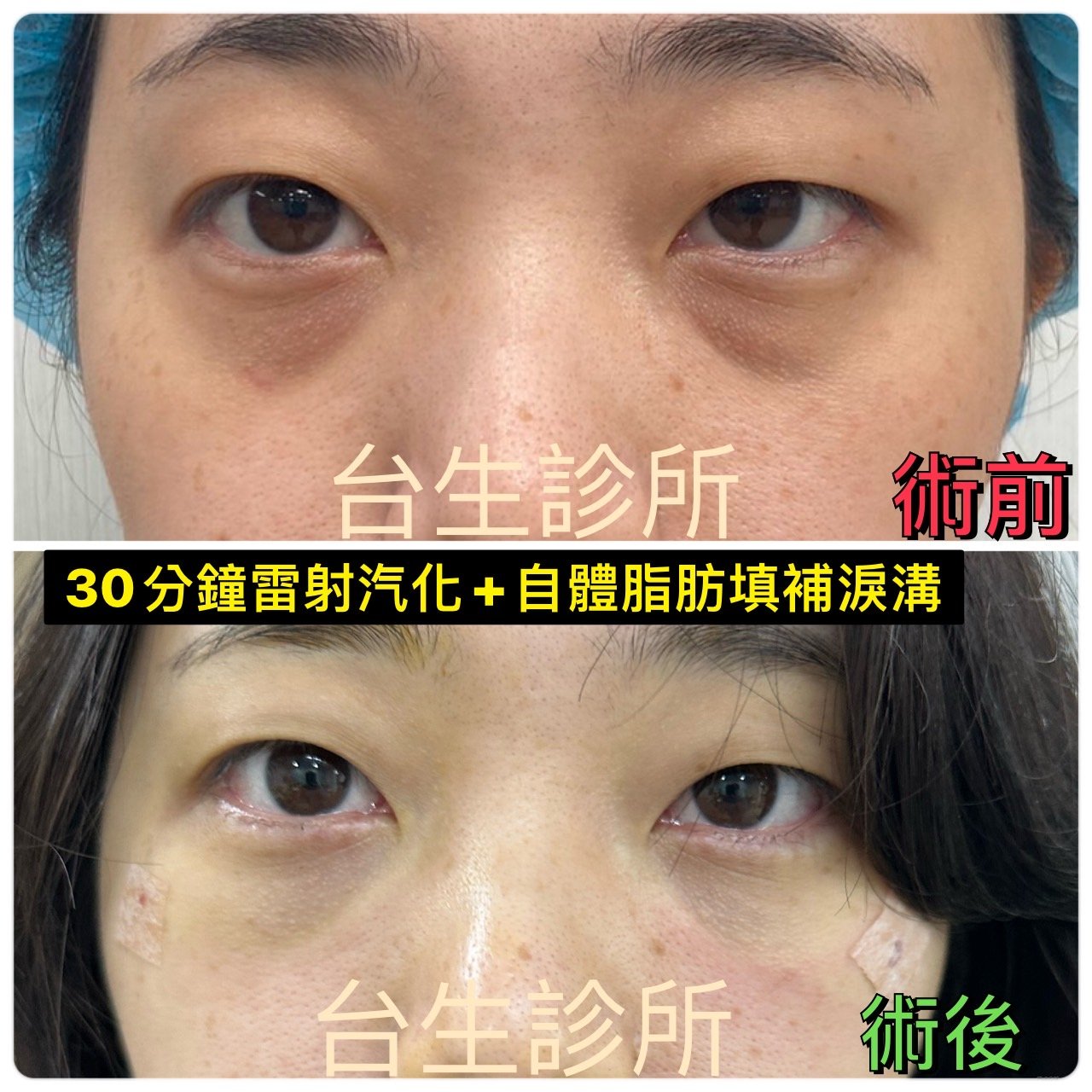 30分鐘雷射汽化眼袋+自體脂肪填補淚溝 - 