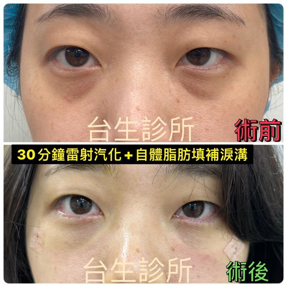 30分鐘雷射汽化眼袋+自體脂肪填補淚溝 - 