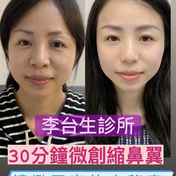 微創永久縮鼻翼術 -