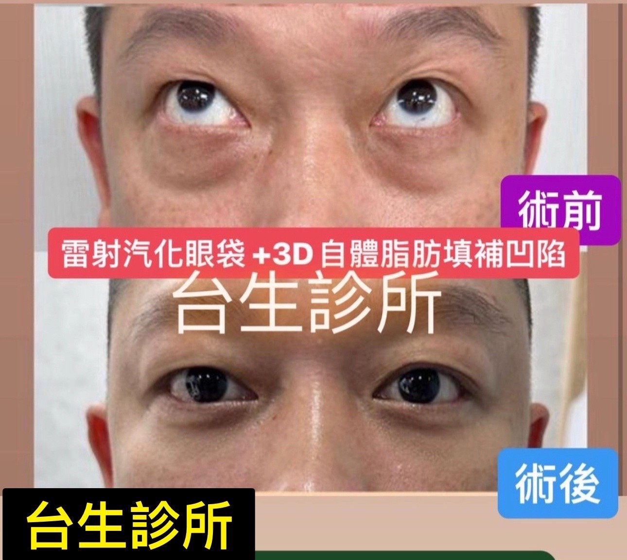 30分鐘雷射汽化眼袋+3D自體脂肪填補淚溝 - 