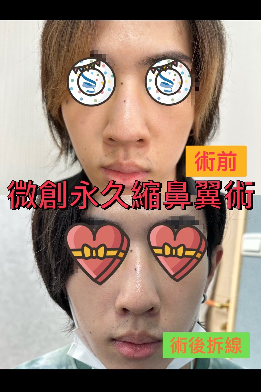 30分鐘微創永久縮鼻翼術後拆線結果 - 