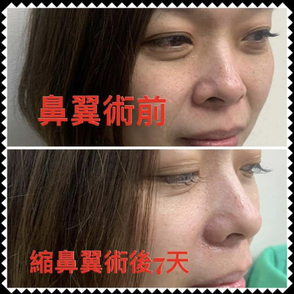 微創縮鼻翼 -