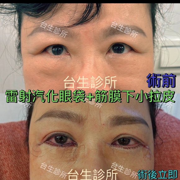 30分鐘雷射汽化眼袋+眼下筋膜拉皮 - 