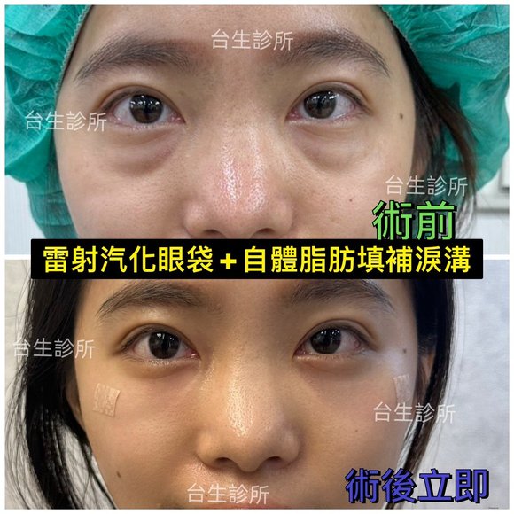 30分鐘雷射汽化眼袋+自體脂肪填補淚溝黑眼圈 - 