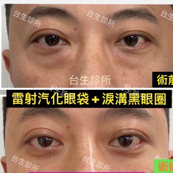30分鐘雷射汽化眼袋+自體脂肪填補淚溝黑眼圈 - 