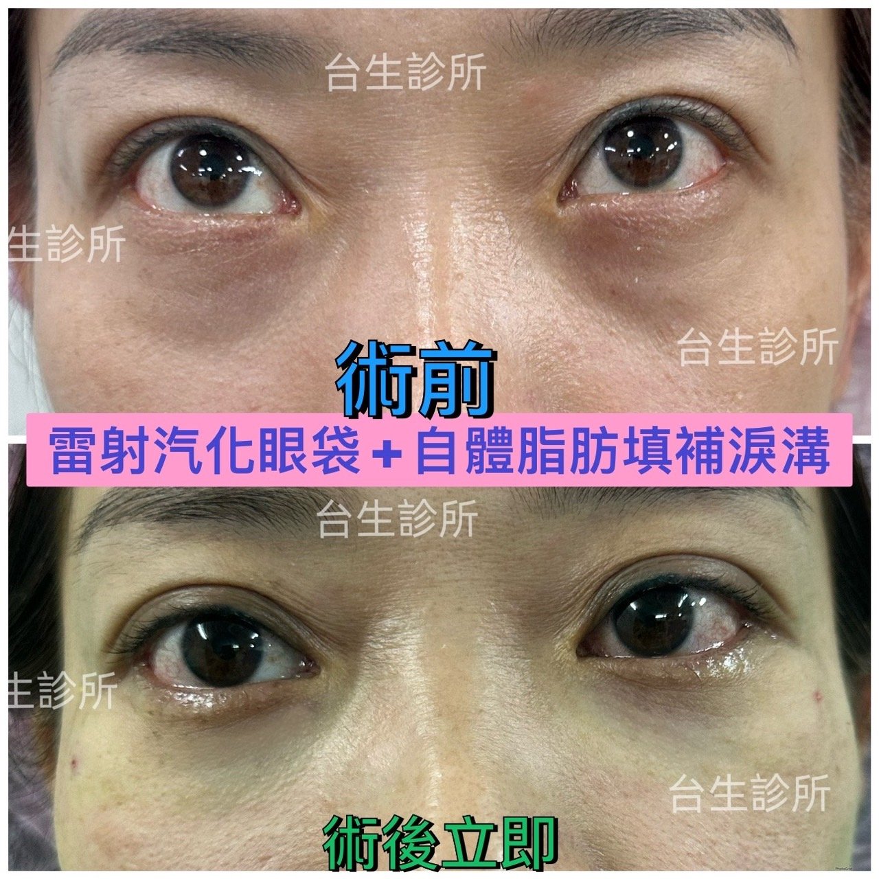 30分鐘雷射汽化眼袋+自體脂肪填補淚溝黑眼圈 - 