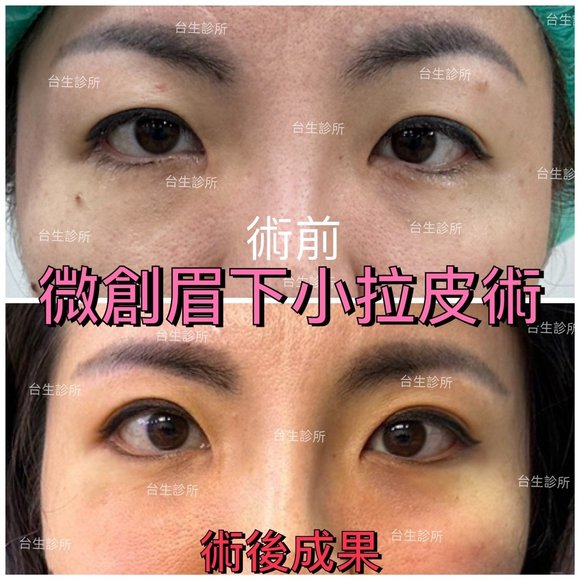 微創眉下小拉皮術~30分鐘雷射汽化眼袋 - 