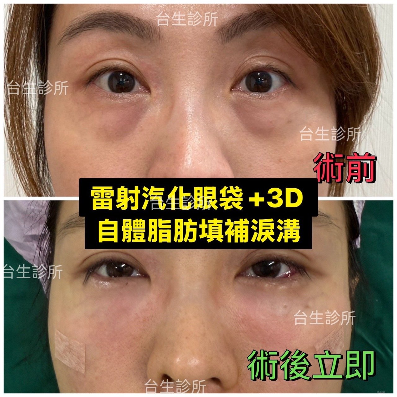 30分鐘雷射汽化眼袋+自體脂肪填補淚溝黑眼圈術後立即效果 - 