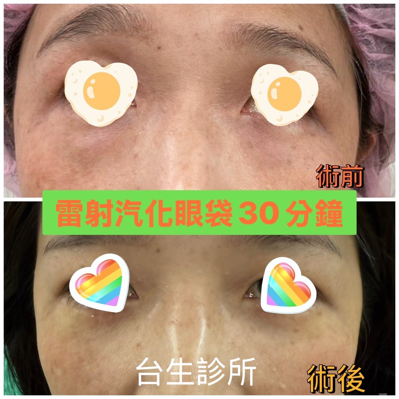 30分鐘無痛雷射汽化眼袋術後效果 - 