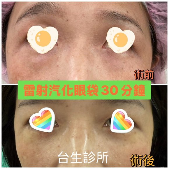 30分鐘無痛雷射汽化眼袋術後效果 - 