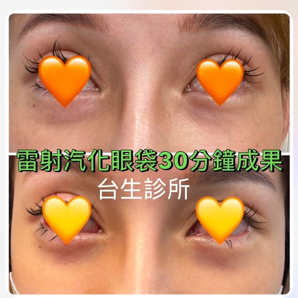 30分鐘無痛雷射汽化眼袋術後效果 - 