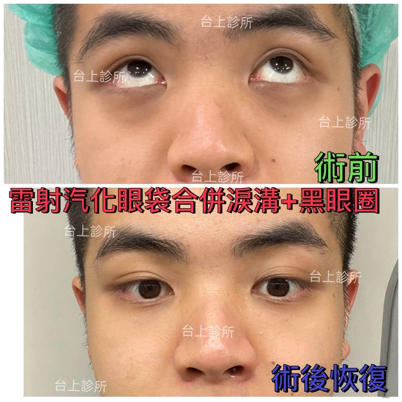 恢復年輕擺脫老態~30分鐘雷射汽化眼袋+3D自體脂肪填補淚溝黑眼圈 - 