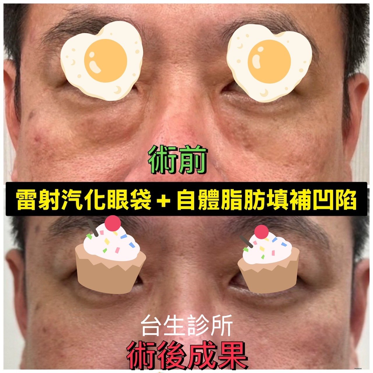 30分鐘無痛雷射汽化眼袋術後效果 - 
