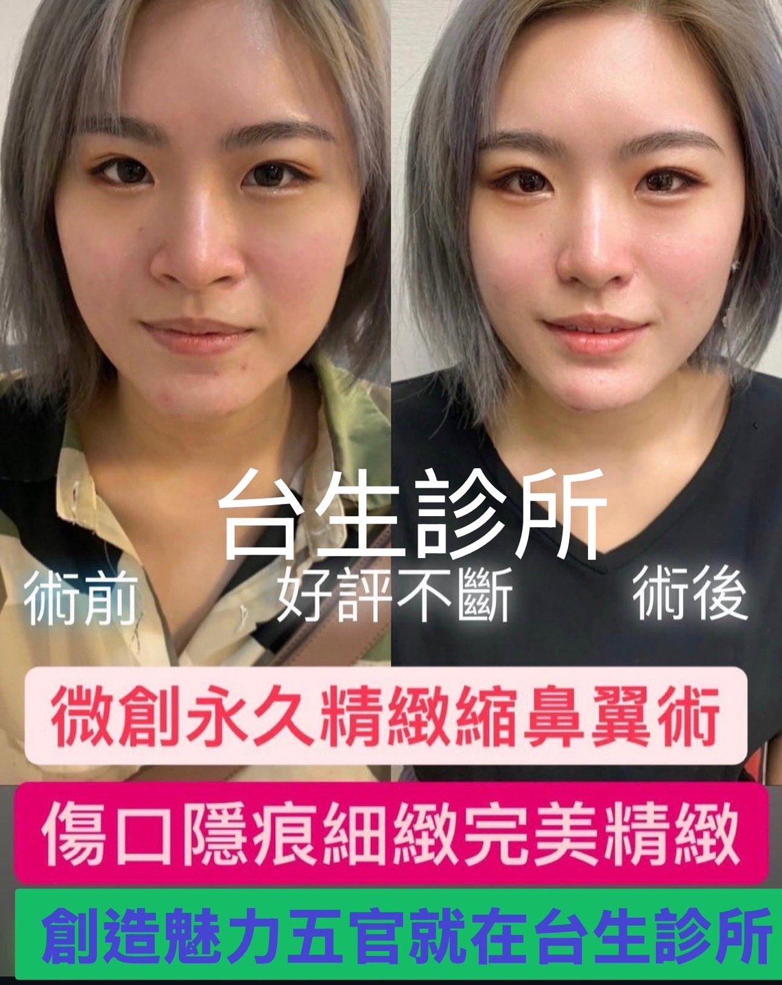 創造魅力五官~ 30分鐘微創永久精緻縮鼻翼術 - 