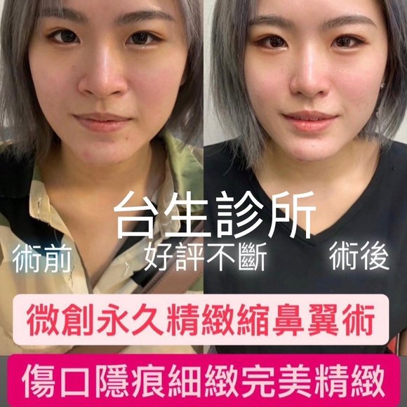 創造魅力五官~ 30分鐘微創永久精緻縮鼻翼術 - 