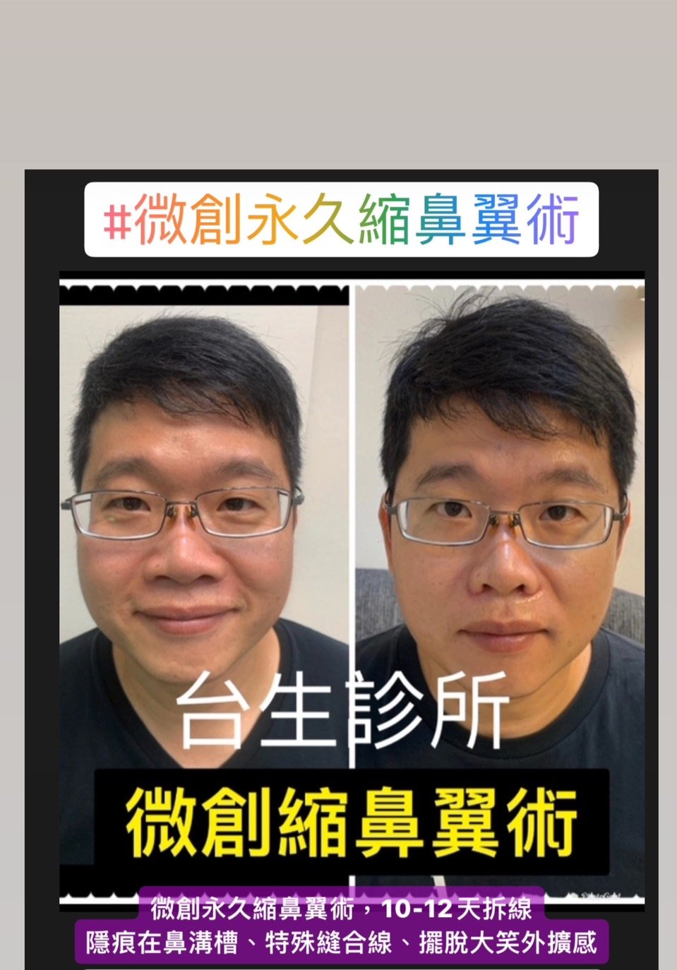擺脫大笑外擴感~ 30分鐘微創永久精緻縮鼻翼術 - 