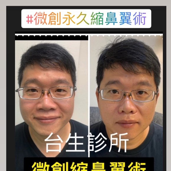 擺脫大笑外擴感~ 30分鐘微創永久精緻縮鼻翼術 - 