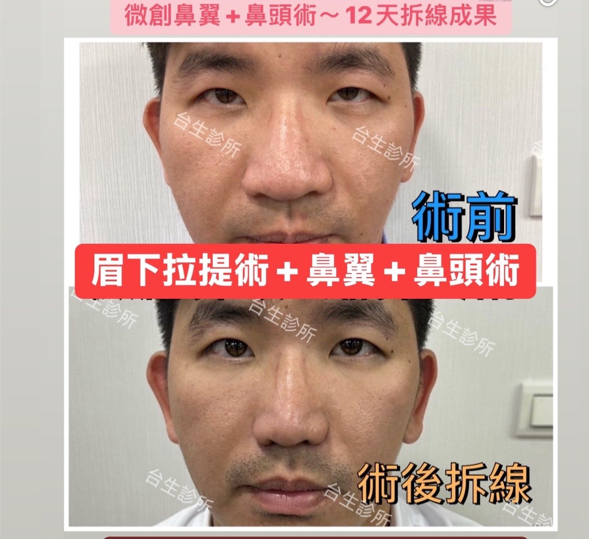 12天拆線成果~ 微創鼻翼+鼻頭術 - 