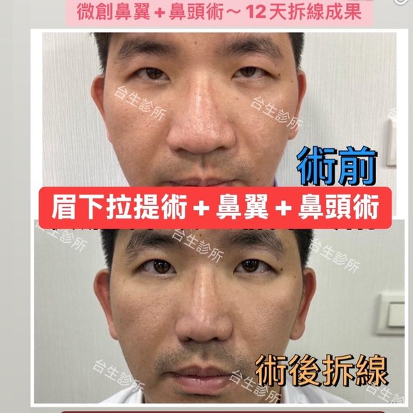 12天拆線成果~ 微創鼻翼+鼻頭術 - 