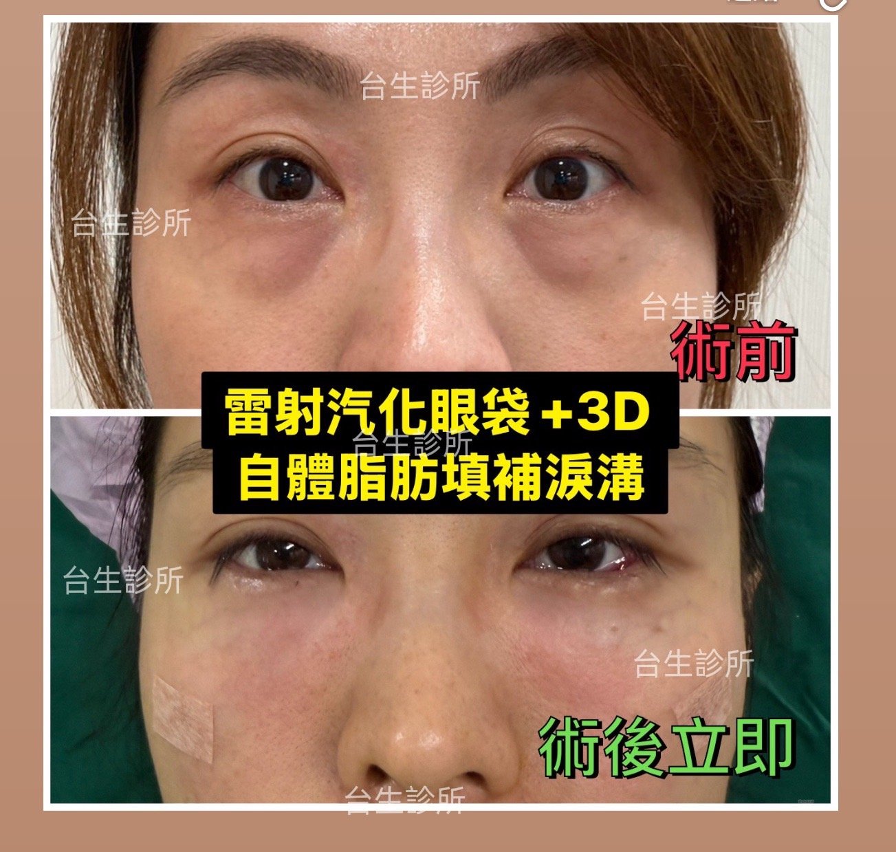 30分鐘雷射汽化眼袋+自體脂肪填補淚溝黑眼圈術後立即效果 - 