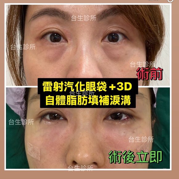 30分鐘雷射汽化眼袋+自體脂肪填補淚溝黑眼圈術後立即效果 - 