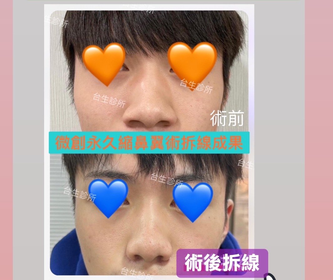 鼻孔變小的手術方式~ 30分鐘微創永久縮鼻翼術 - 