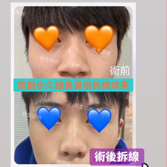 鼻孔變小的手術方式~ 30分鐘微創永久縮鼻翼術 - 